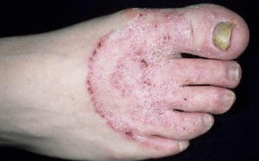 Les raisons de l'apparence du champignon dans les jambes