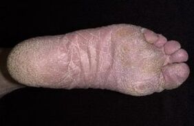 Signes et symptômes des jambes dans les jambes