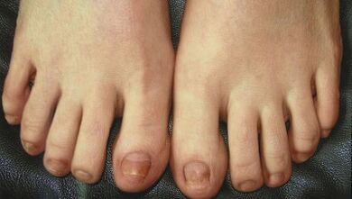 Étapes du développement des champignons à ongles